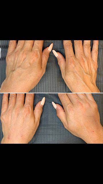 botox for hands