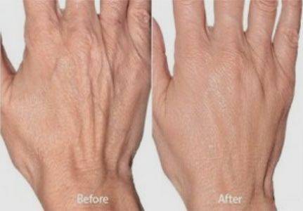 botox for hands