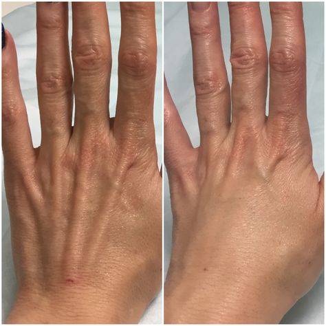 botox for hands