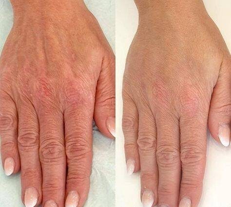 botox for hands