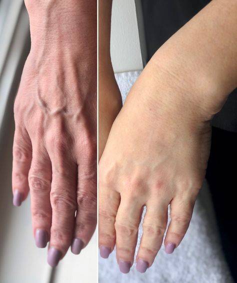 botox for hands