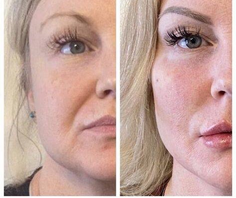 botox for smile lines