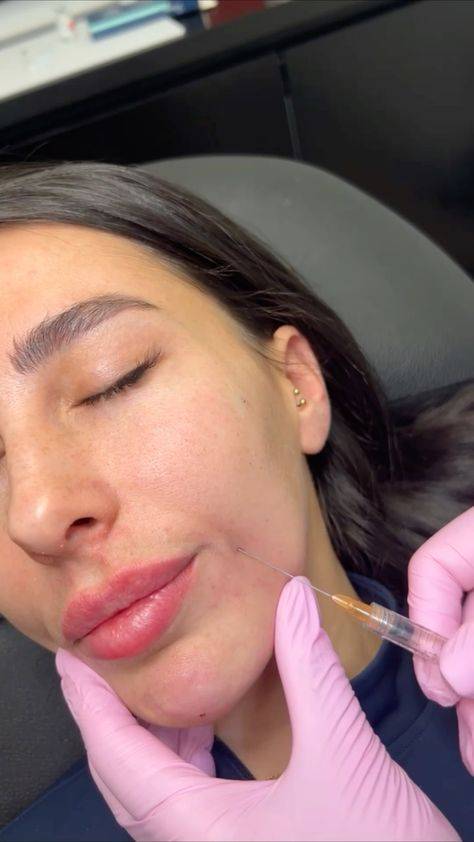 botox for smile lines