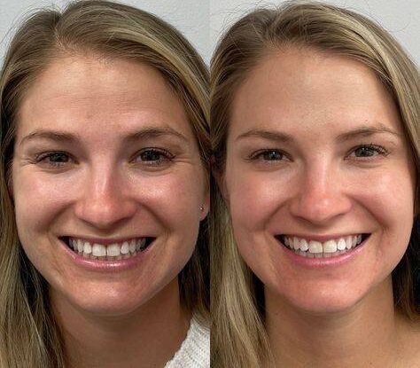 botox for smile lines