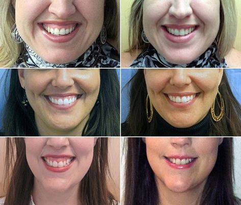 botox for smile lines