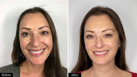 botox for smile lines