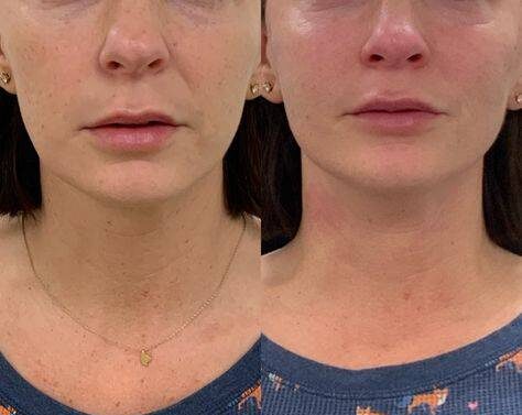 botox for smile lines