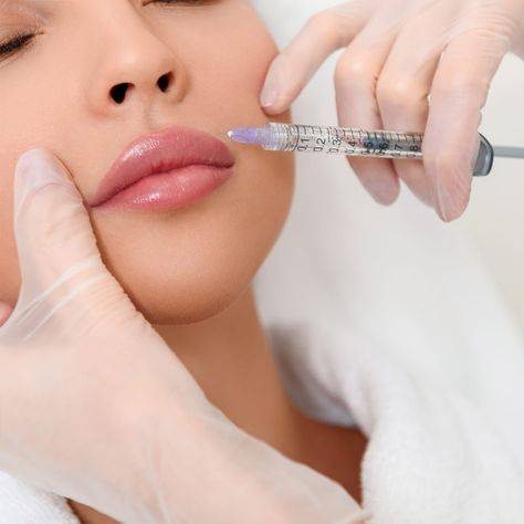 botox for smile lines