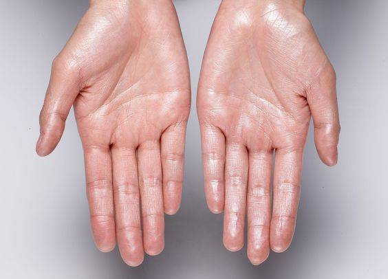 botox for sweaty hands