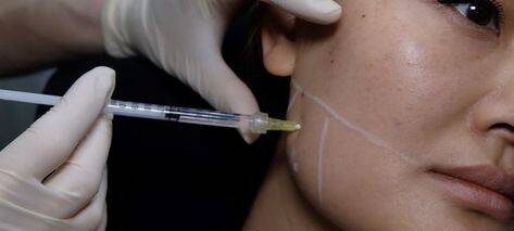 botox for teeth grinding