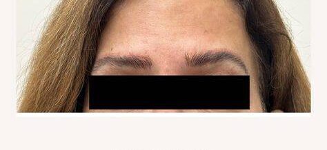 botox forehead before and after