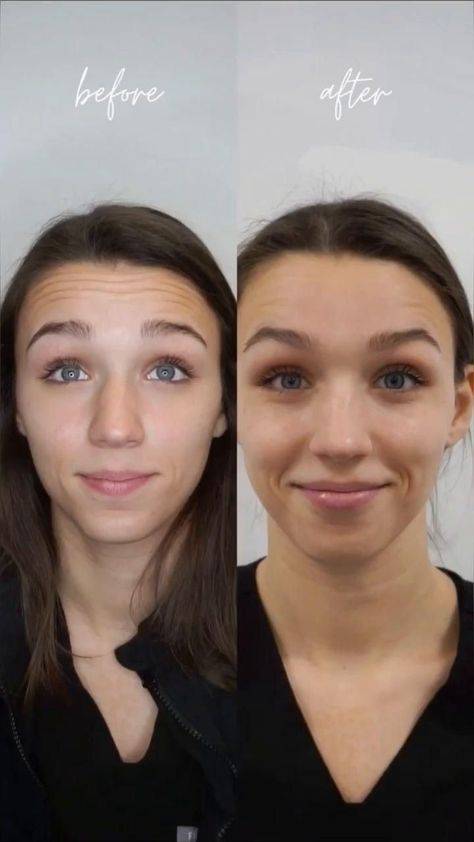 botox forehead before and after