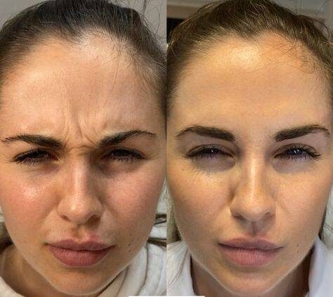 botox forehead before and after