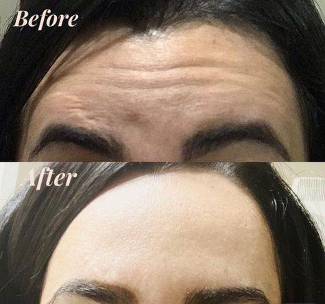 botox forehead before and after