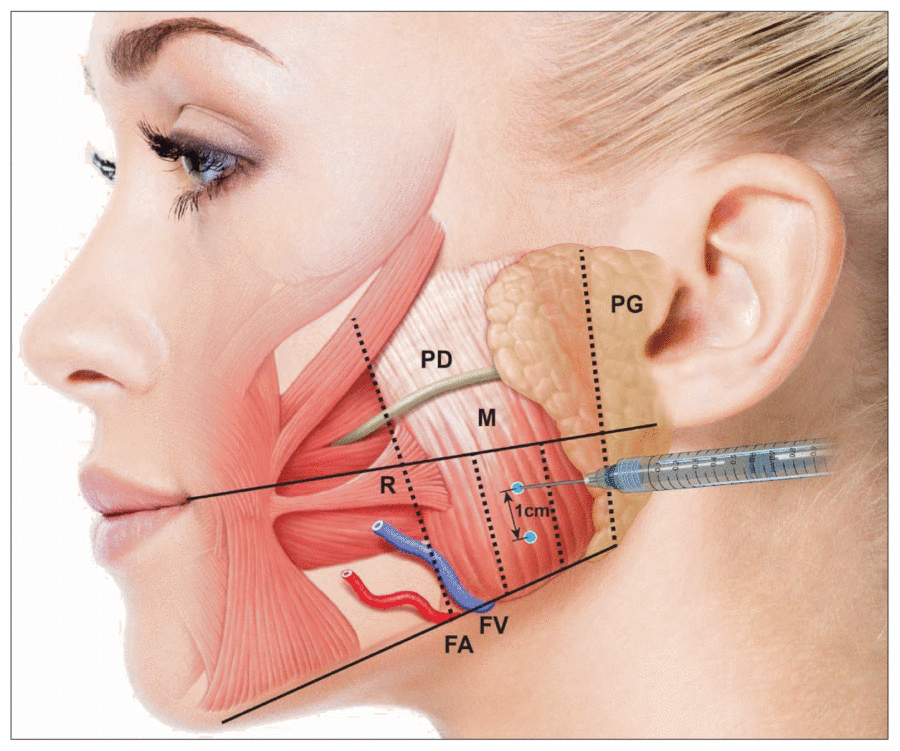 Botox in Jaw to Slim Face