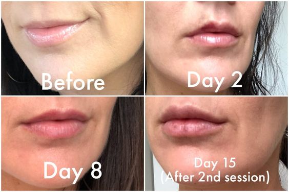 Botox Lip Flip Before and After