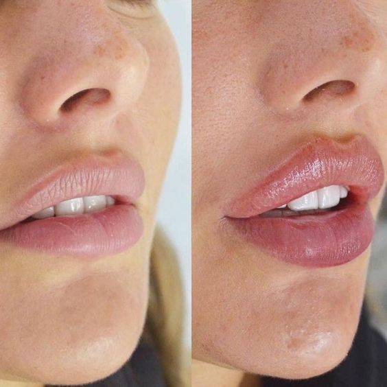 botox lip flip gone wrong