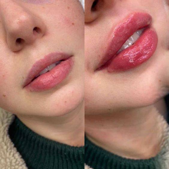 botox lip flip gone wrong