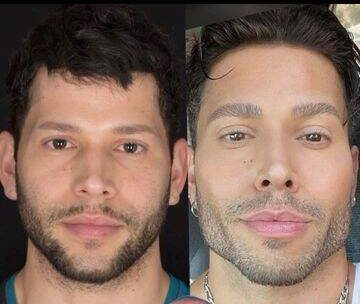 botox mens before and after