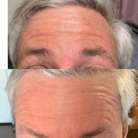 botox mens before and after