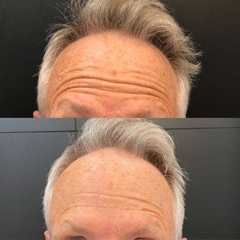 botox mens before and after