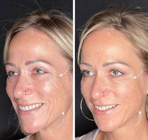 botox smile lines