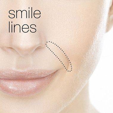 botox smile lines