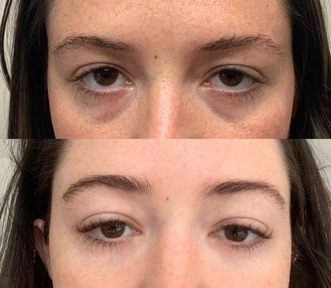 botox under eyes before and after