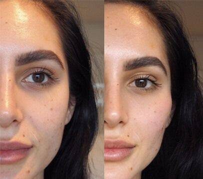 botox under eyes before and after