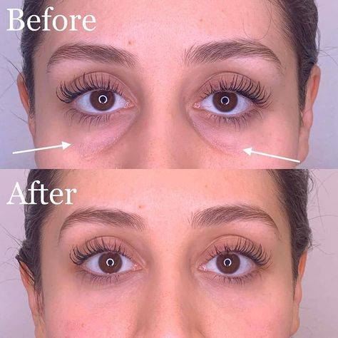 botox under eyes before and after