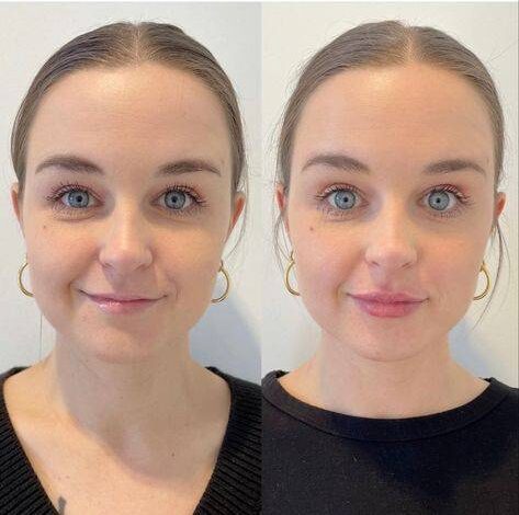 botox under eyes before and after