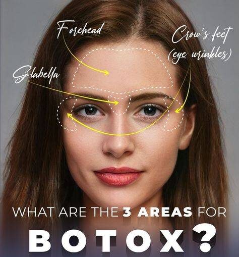 botox vs fillers 