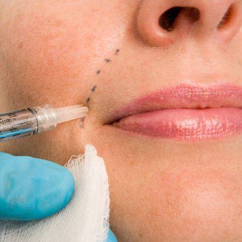 breast filler injections