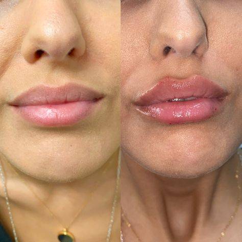 breast filler injections