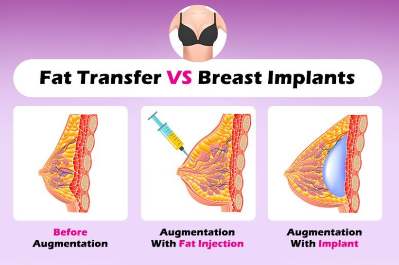 Breast Filler vs Implant