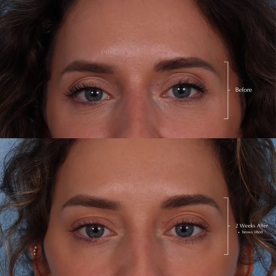 Brow Lift with Botox