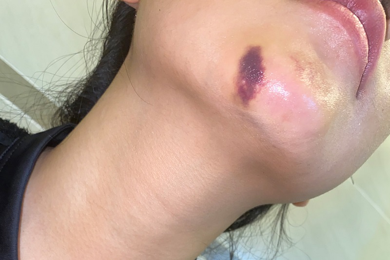 Bruise on cheek after filler injection