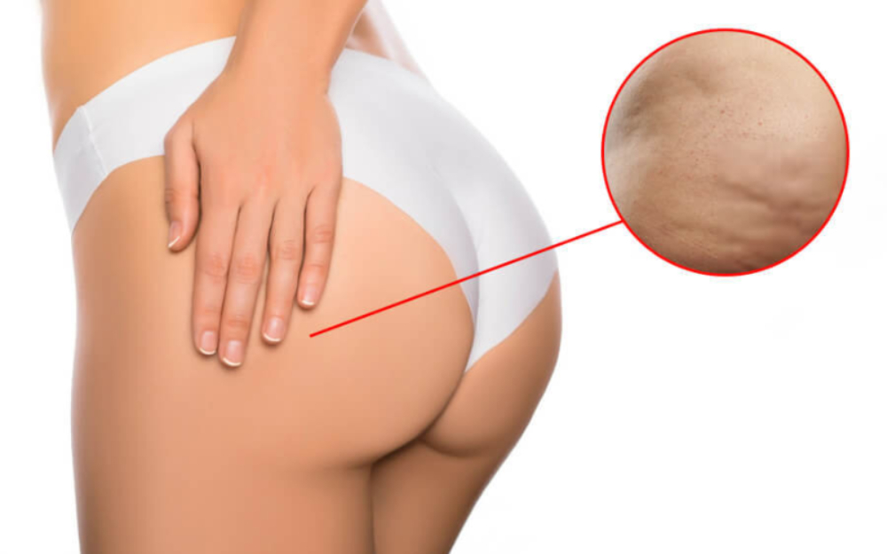 buttock skin care after botox injection