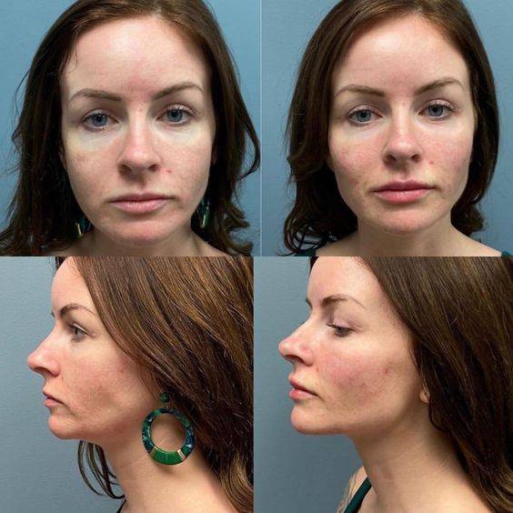 Fillers for sunken cheeks before and after