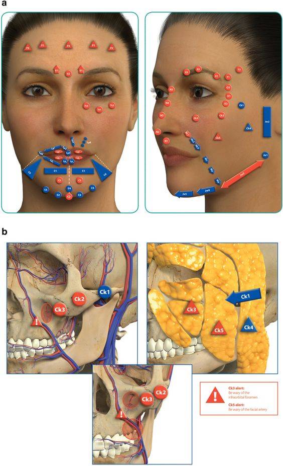 cheek filler injection technique