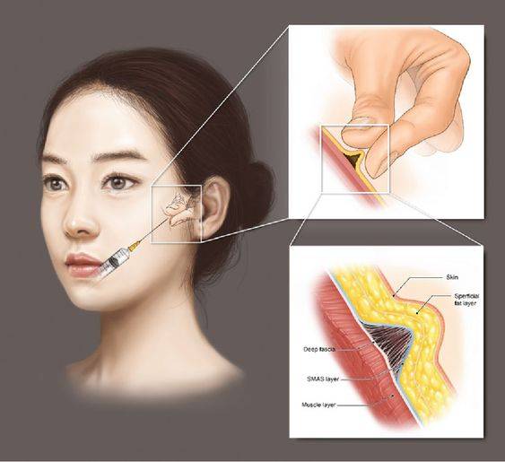 cheek filler injection technique