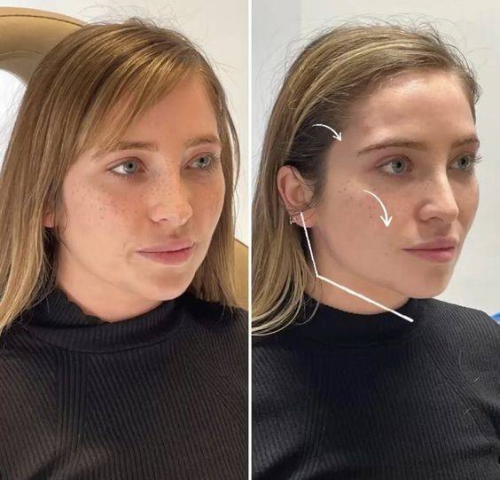 cheek filler injection technique