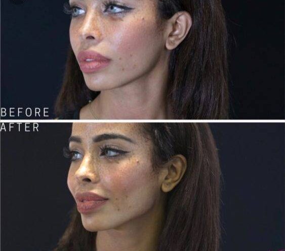 cheek filler injection technique