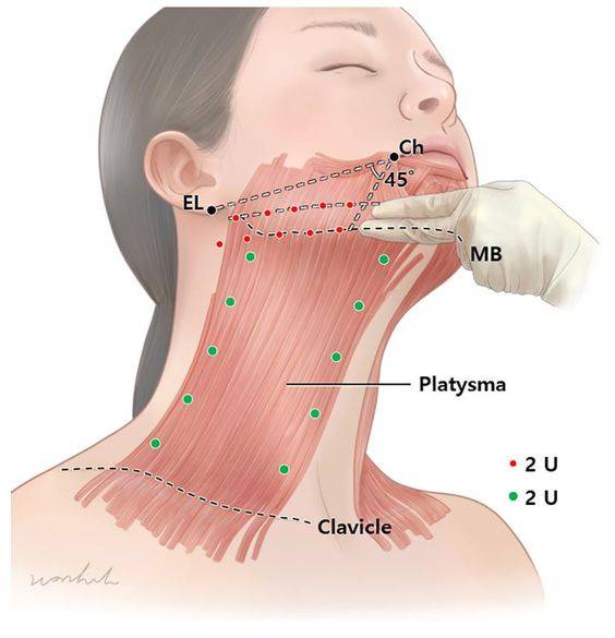 cheek injections