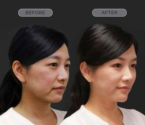 chin botox before and after