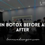 Chin Botox Before and After