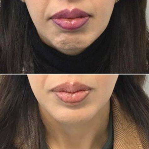 chin botox before and after