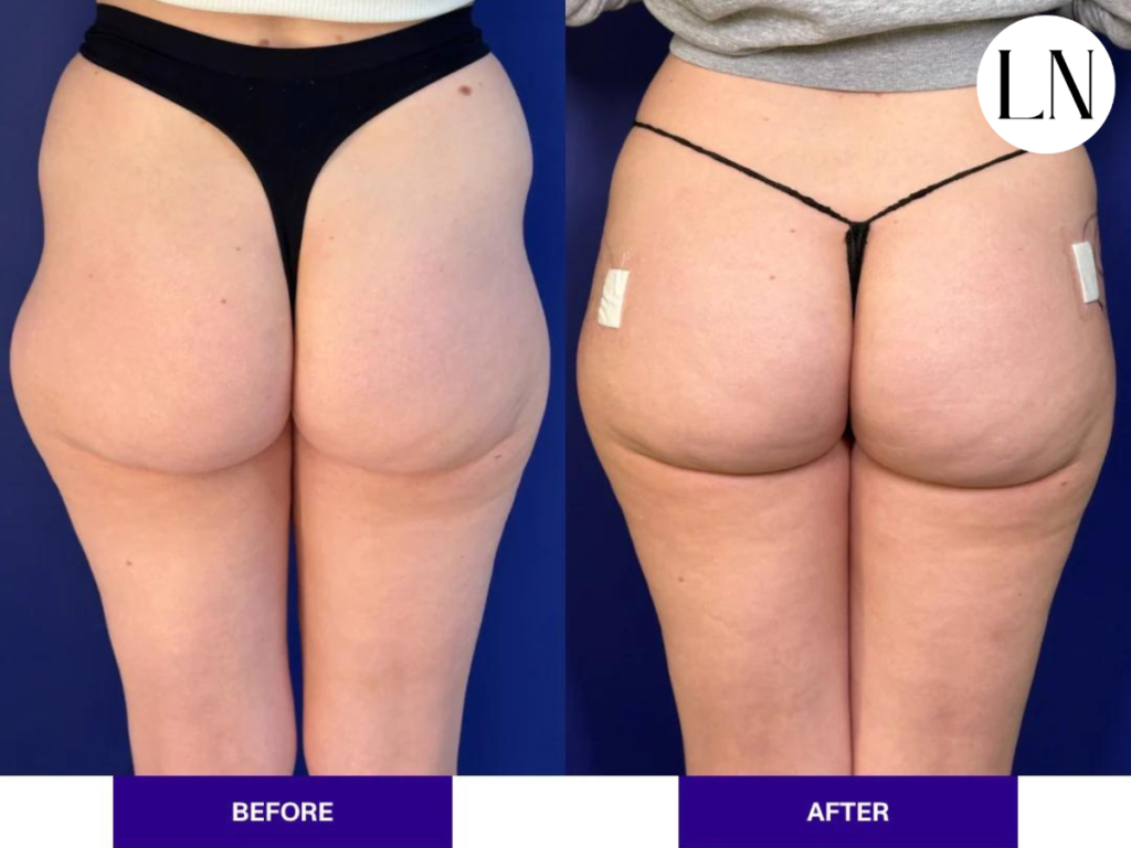 Choosing the Right Bum Filler Course