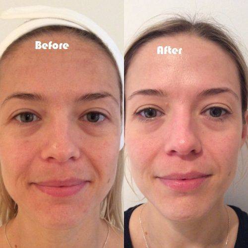 collagen cheek injections