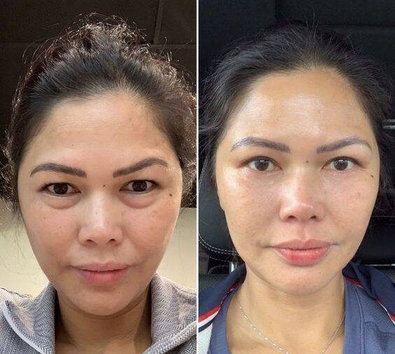 collagen cheek injections